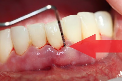  Điều trị chảy máu chân răng sau khi lấy cao răng 