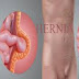 हर्निया के घरेलु उपचार - Herbal Home Remedies For Hernia.