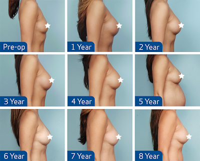 Antes e Depois Mamoplastia de Aumento Antes e Depois Mamoplastia de Aumento