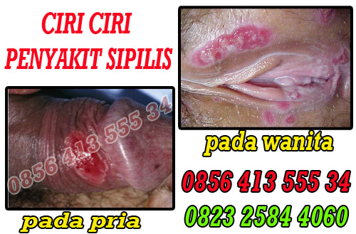 Obat Sipilis Di Apotik De Nature Indonesia Untuk Wanita