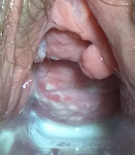 vaginal-kandidiasis vaginal-kandidiasis