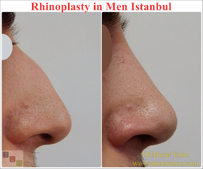 Nose Job Surgery for Men - Male Rhinoplasty - Men's Rhinoplasty - Nose Reshaping for Men - Mens Rhinoplasty - Nose Job Rhinoplasty for Men - Best Rhinoplasty For Men Istanbul - Nose Aesthetic for Men - Male Nose Operation - Male Rhinoplasty Surgery in Istanbul - Male Rhinoplasty Surgery in Turkey - Male Nose Aesthetic Surgery - Rhinoplasty In Mens