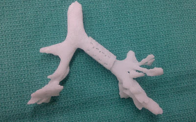 3D printed cast for splint