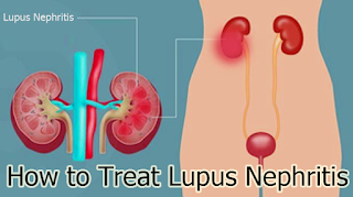 How to Treat Lupus Nephritis