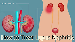 How to Treat Lupus Nephritis How to Treat Lupus Nephritis