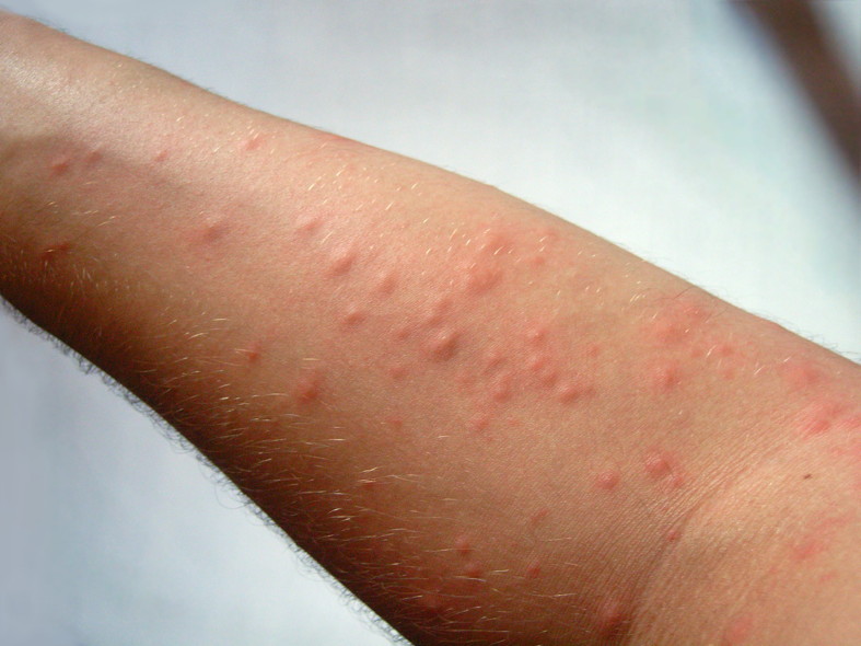 Dermatite di eczemi trichophytia