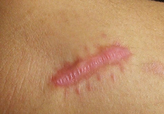 kumpulan obat salep keloid di apotik paling uh kumpulan obat salep keloid di apotik paling uh