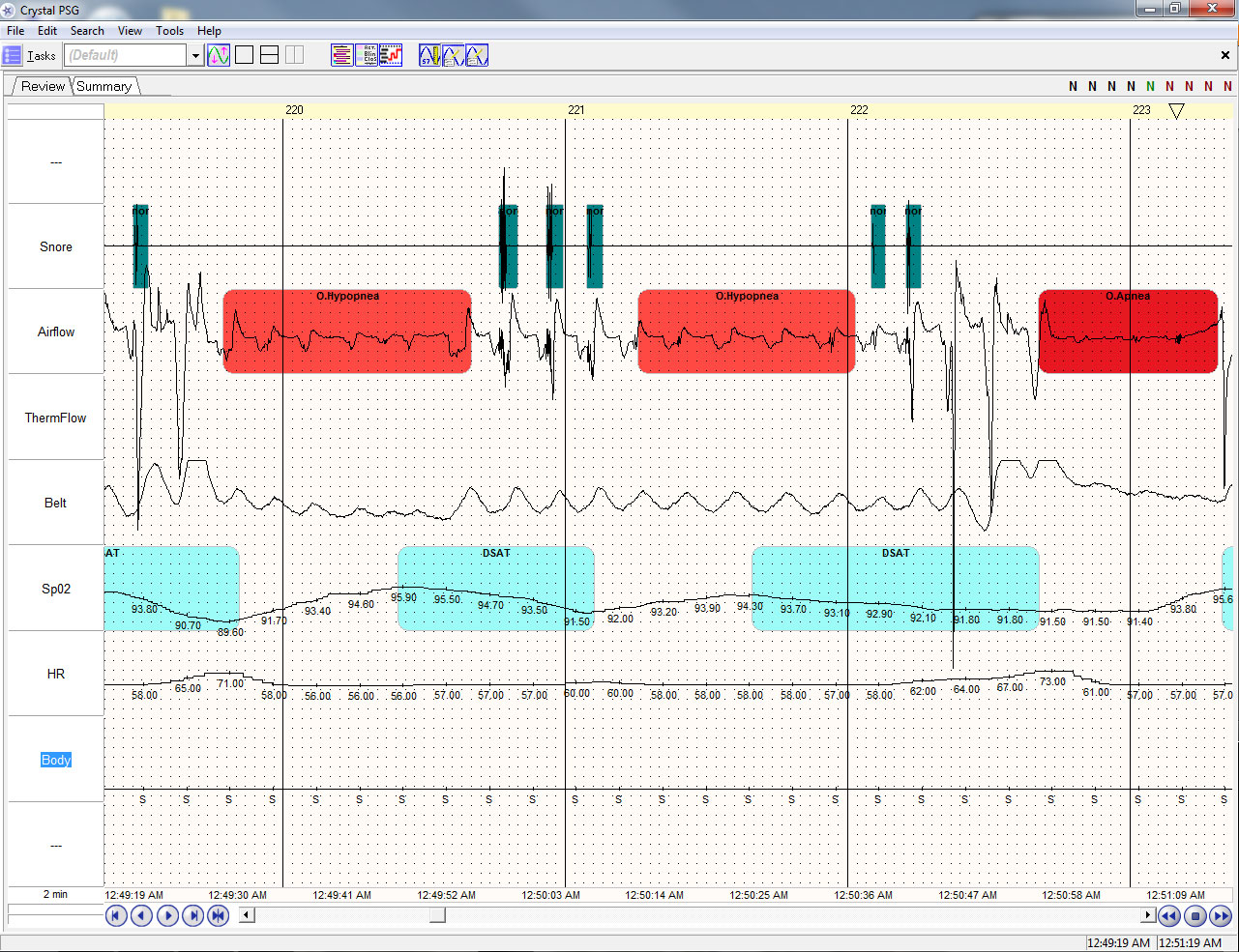SleepView Home Sleep Testing