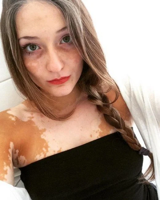 Italiana con Vitiligo se convierte en una Modelo Exitosa