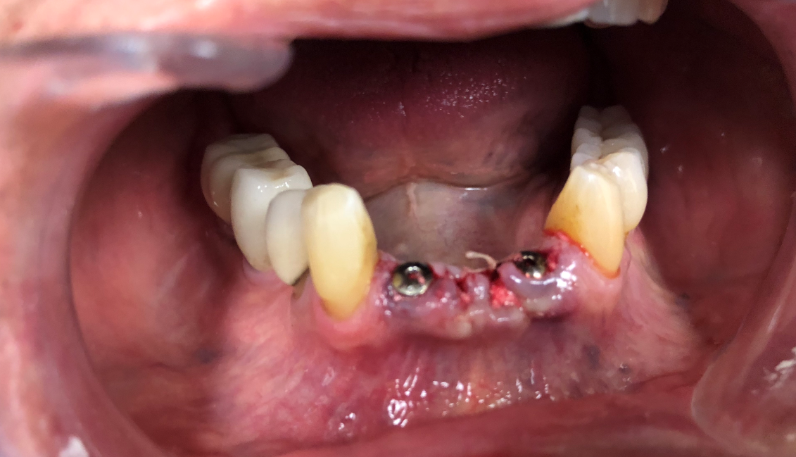Immediate Dental Implant Placement in the Anterior Aesthetic Zone