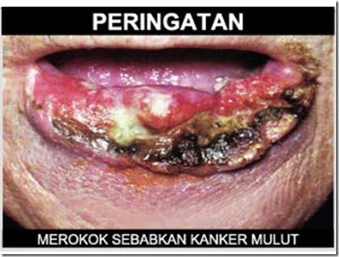 https://4.bp.blogspot.com/--LHuPo9q2II/WFzQA3-8RJI/AAAAAAAAATE/Ar1uZpS6gQssrj6Nq_2dBlBL8PPQUsAhACLcB/s1600/Merokok-Sebabkan-Kanker-Mulut.jpg