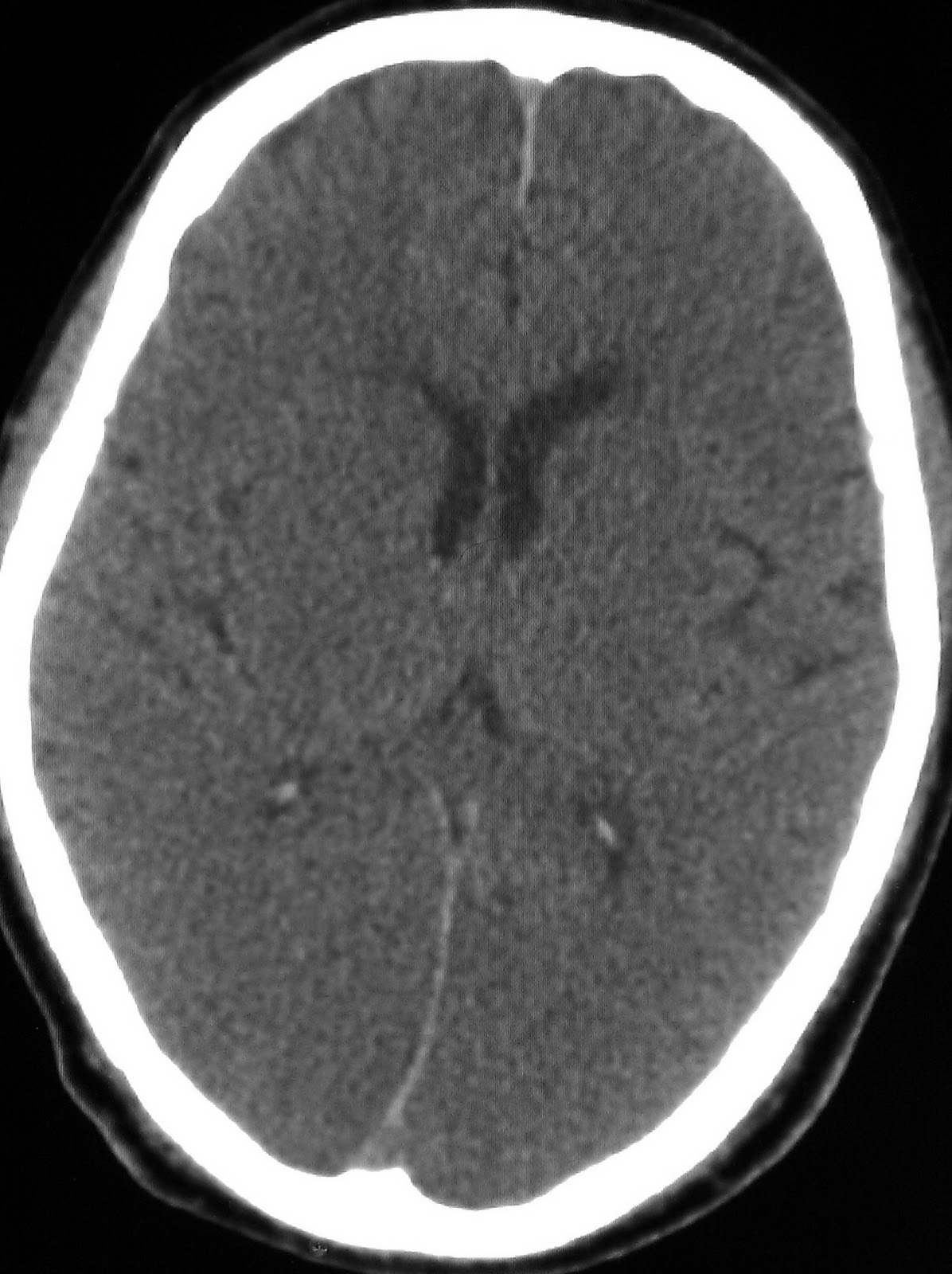 Learning Neuroradiology: Case 93 - Diffuse Hypoxic Brain Injury