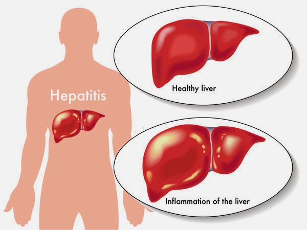 Penyebab Penyakit Hepatitis Viral Dunia Alat Kedokteran