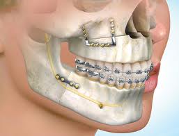 Metode Perhitungan Ortodontik