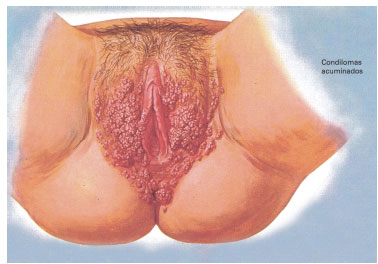 Papiloma humano en el cuello uterino imagenes