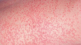 virus rubella dan toxoplasma virus rubella dan toxoplasma
