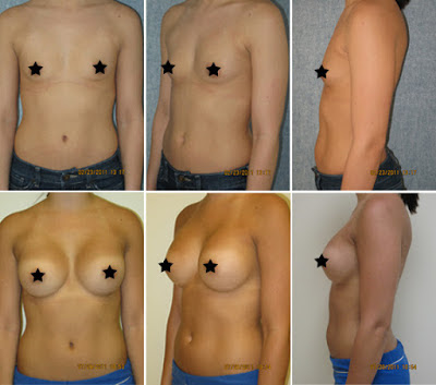Antes e Depois Mamoplastia de Aumento Antes e Depois Mamoplastia de Aumento