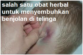 salah satu obat herbal untuk menyembuhkan benjolan di telinga salah satu obat herbal untuk menyembuhkan benjolan di telinga