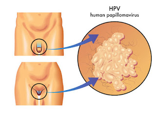 Does HPV Cause Ovarian Cancer Does HPV Cause Ovarian Cancer