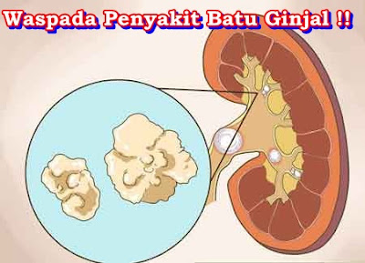 Cara Menghancurkan Batu Ginjal Yang Besar Tanpa Operasi Sampai Tuntas Cara Menghancurkan Batu Ginjal Yang Besar Tanpa Operasi Sampai Tuntas
