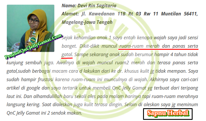 Cara Mengobati Eksim Kering Secara Alami Terbukti Mujarab ~ TESTIMONI QNC JELLY GAMAT Cara Mengobati Eksim Kering Secara Alami Terbukti Mujarab ~ TESTIMONI QNC JELLY GAMAT