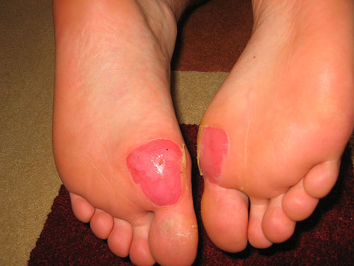 Blister On Heel From Soccer Shoes Blister On Heel From Soccer Shoes