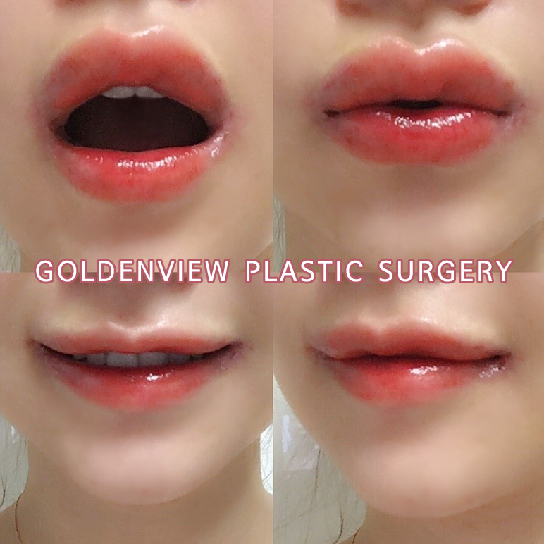 Goldenview Plastic surgery lips plastic surgery before and after
