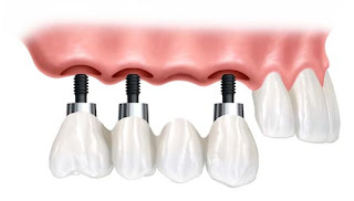 Cấy ghép implant ở đâu tốt tại tphcm