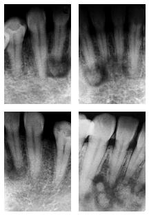 PDQ ORAL DISEASE: Periapical Cemento-osseous Dysplasia