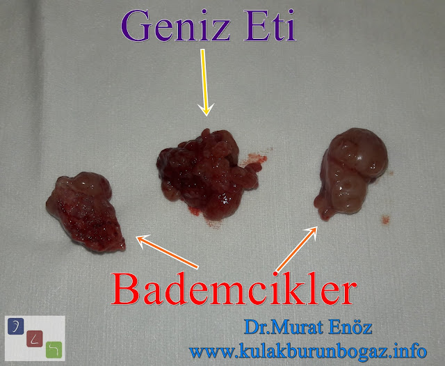 Geniz Eti Ameliyatı Sonrası, Geniz Etinin Tekrar Büyümesinin Nedenleri