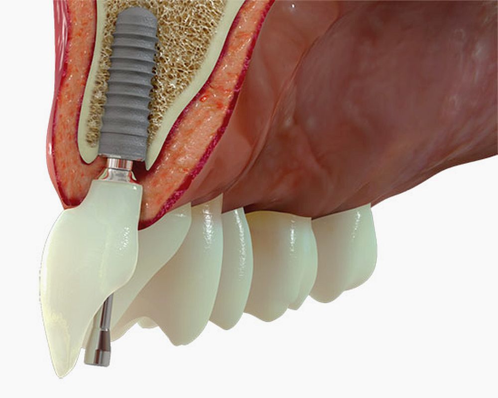 Implantes Dentarios