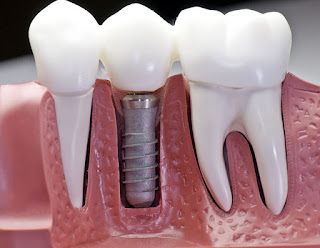 Trồng răng số 7 có thực sự cần thiết không? Trồng răng số 7 có thực sự cần thiết không?