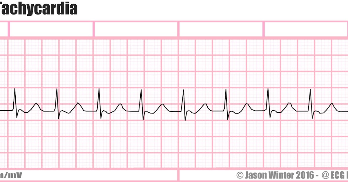 ECG Educator Blog Junctional Tachycardia