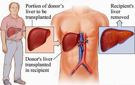  Liver Transplantation Liver transplantation is surgery to remove a diseased liver and replace it with a healthy liver from an organ donor. A liver transplant is necessary when disease makes the liver stop working. The most common reason for liver transplantation in adults is cirrhosis, a disease in which healthy liver cells are killed and replaced with scar tissue. The most common reason for transplantation in children is biliary atresia, a disease in which the ducts that carry bile out of the liver are missing or damaged.   Liver transplantation is usually done when other medical treatment cannot keep a damaged liver functioning. About 80 to 90 percent of people survive liver transplantation. Survival rates have improved over the past several years because of drugs like cyclosporine and tacrolimus that suppress the immune system and keep it from attacking and damaging the new liver.