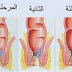 علاج البواسير الداخلية بجميع درجاتها