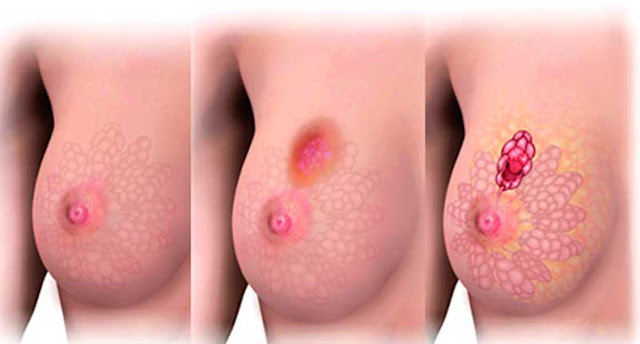 5 Metastatic Breast Cancer Symptoms You Should Know ! 5 Metastatic Breast Cancer Symptoms You Should Know !