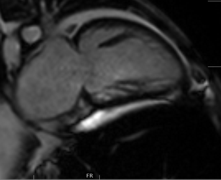 Myocardial Iron EstimationMRI Sumer's Radiology Blog