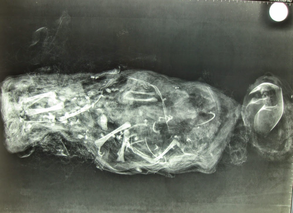 Mummified fetus reveals ancient surgical procedure
