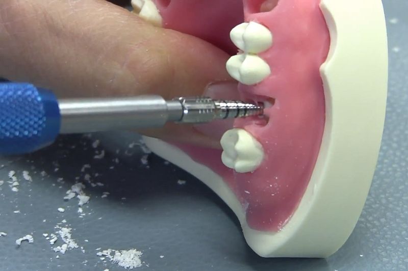 IMPLANTOLOGY Immediate placement in molar site utilizing bone