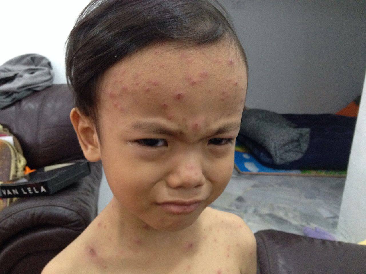 Pantang Larang Chicken Pox - Chicken Pox Babycenter - Ubat chicken pox