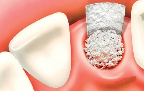 LÀM RĂNG IMPLANT Ở ĐÂU TỐT?