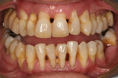 hiện tượng tụt lợi chân răng hiện tượng tụt lợi chân răng