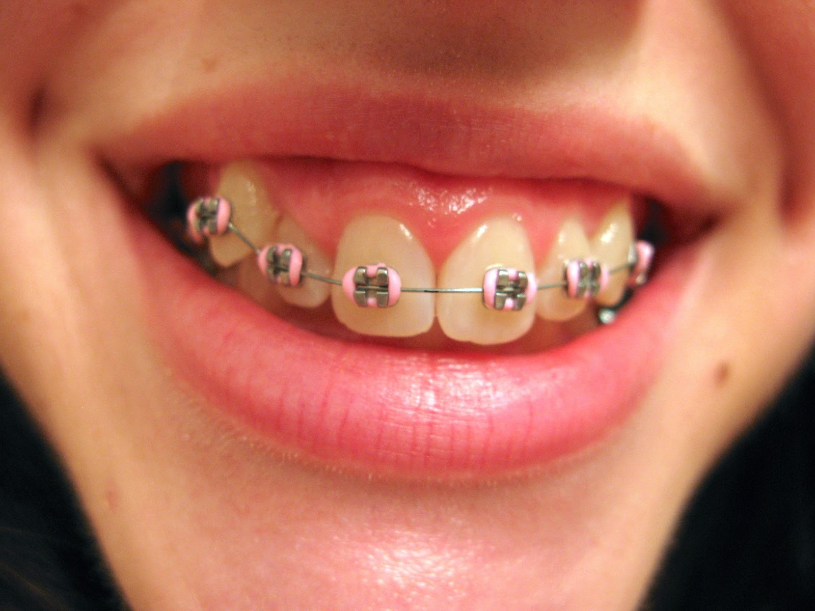Braces at 22.