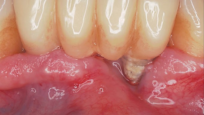 PERIODONCIA: Etiopatogénesis de las enfermedades periodontales y perimplantares