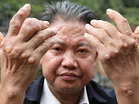 Mengobati Kutil di Area Kelamin Mengobati Kutil di Area Kelamin