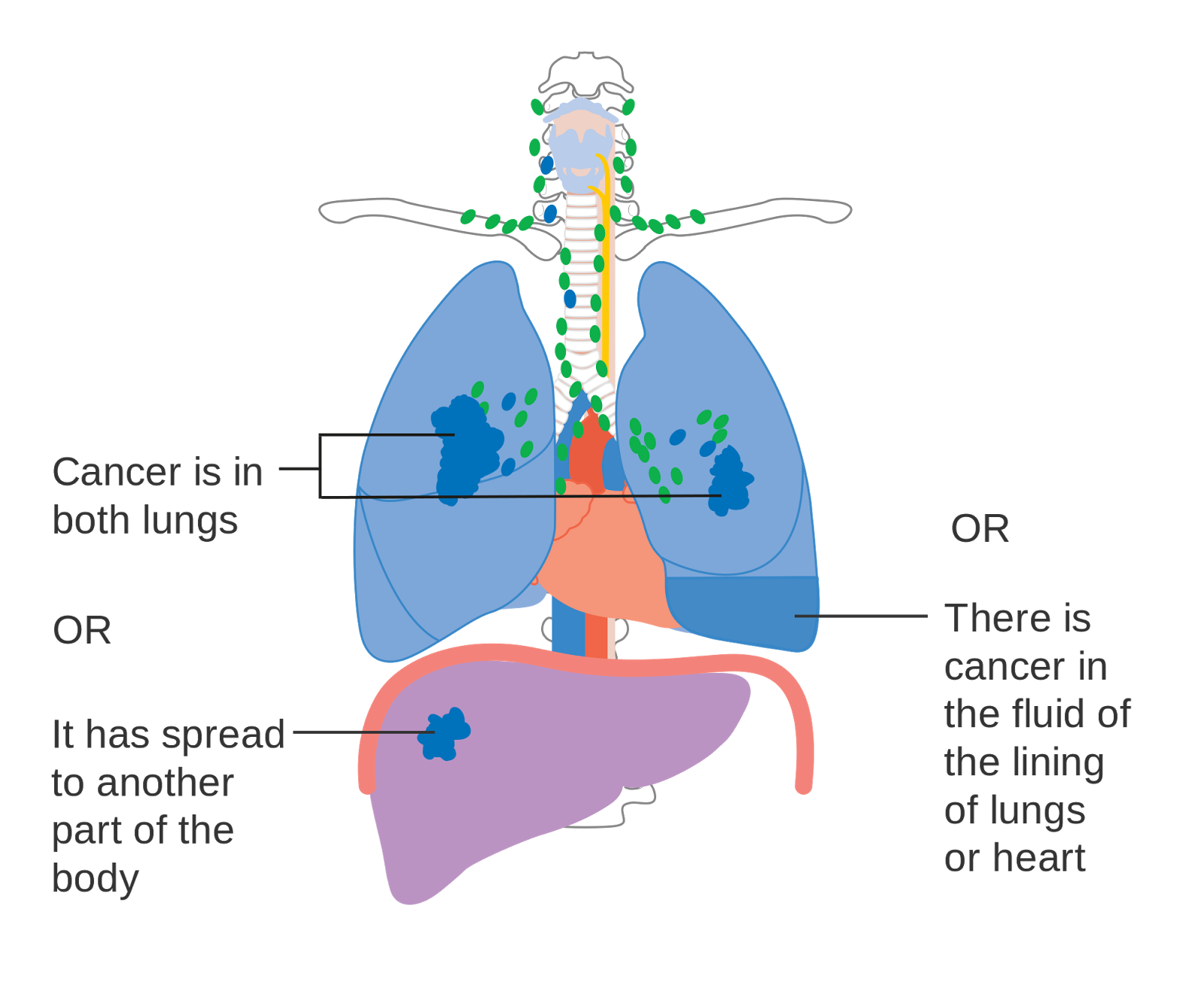 Tests and stage of lung cancer Mesothelioma Focus