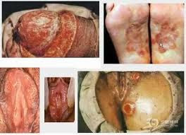 Obat Ampuh Penyakit Sipilis Raja Singa Obat Ampuh Penyakit Sipilis Raja Singa