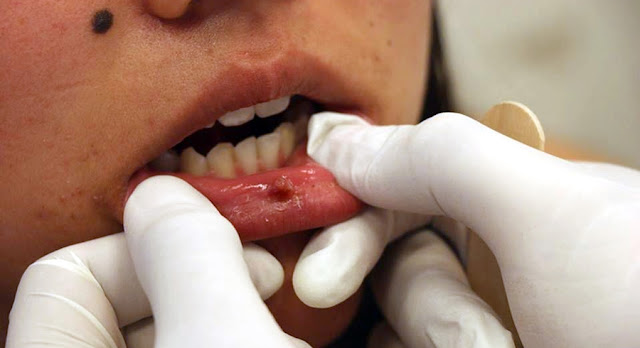 La BUAP se suma a la prevención del cáncer oral