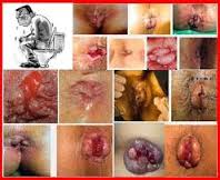 Foto Obat Herbal Wasir Dalam Ambeclear Ampuh Tanpa Operasi