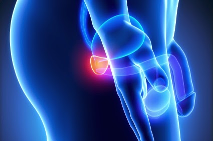 cáncer de próstata y vitamina d d